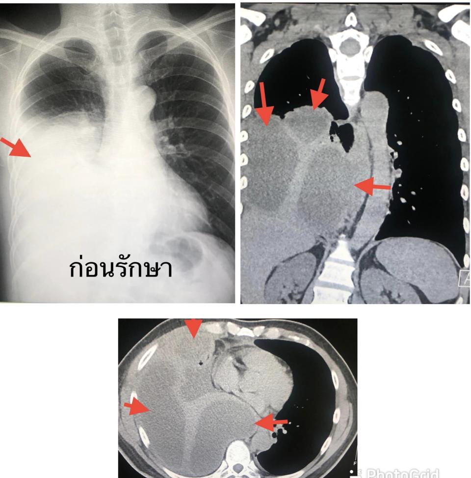 男子蛀牙嚴重，導致細菌感染到胸腔。（圖／翻攝自馬努醫師臉書）