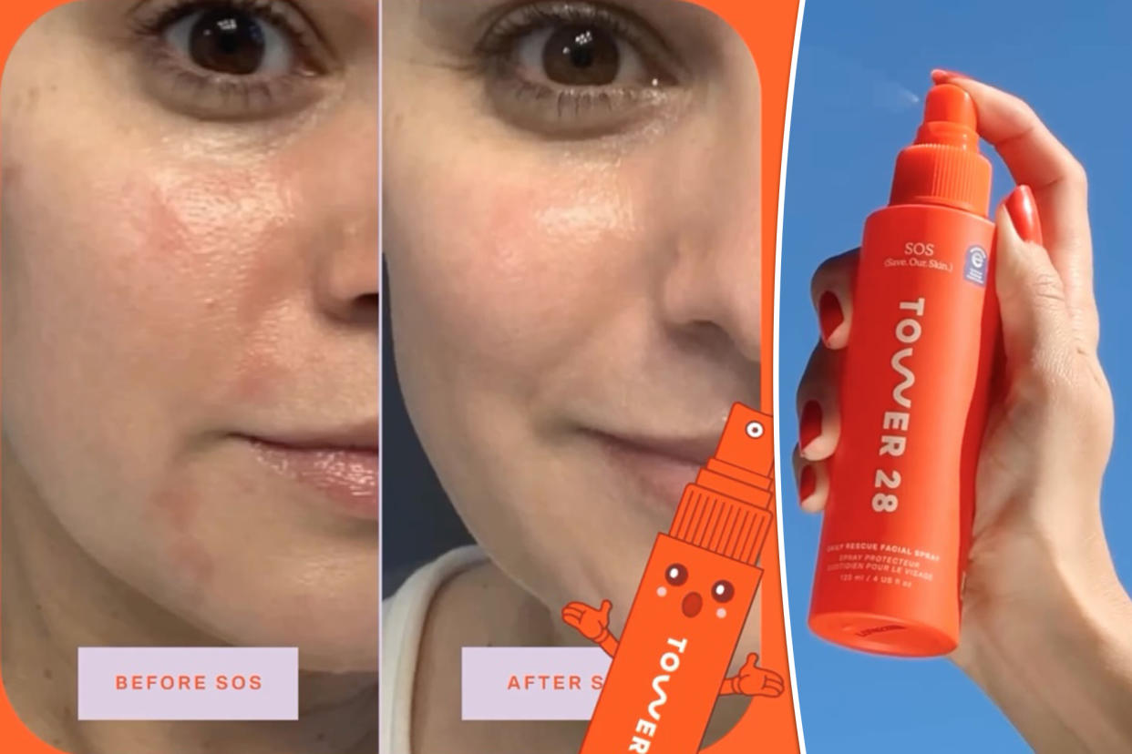 Hypochlorous Acid Sprays Are the Latest Buzzy Acne Treatment