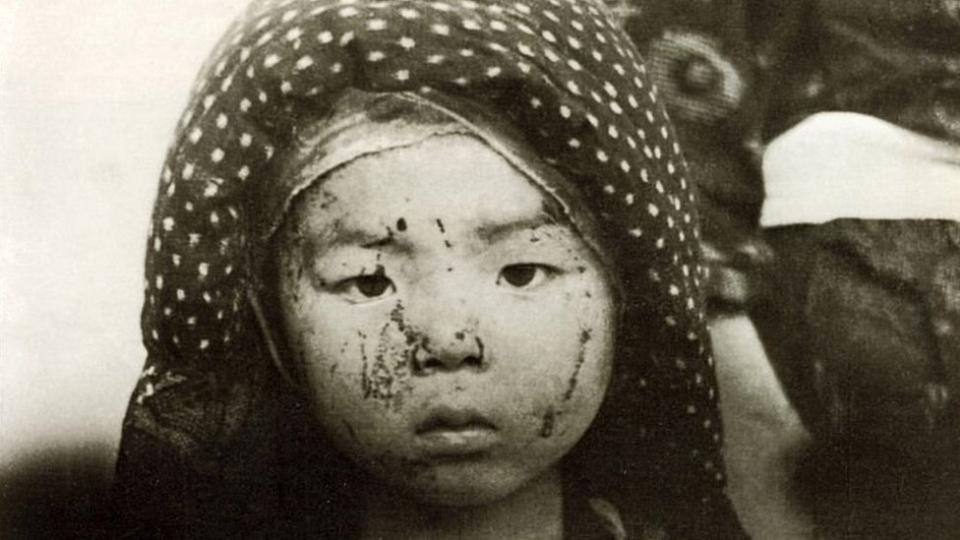 Niño sobreviviente de la bomba de Nagasaki con heridas en la cara.