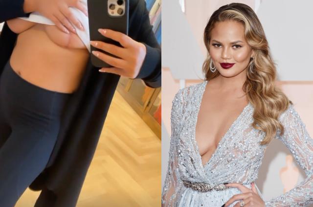 Chrissy Teigen shows breast implant removal scars