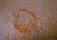 CDC/Dr. Lucille K. Georg Ringworm