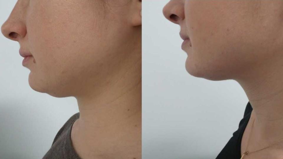 two photos showing results of kybella injectable treatment before and after