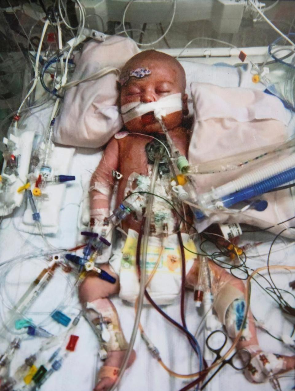 James Baker at 6 weeks old, after his heart transplant at Cincinnati Children's Hospital Medical Center.