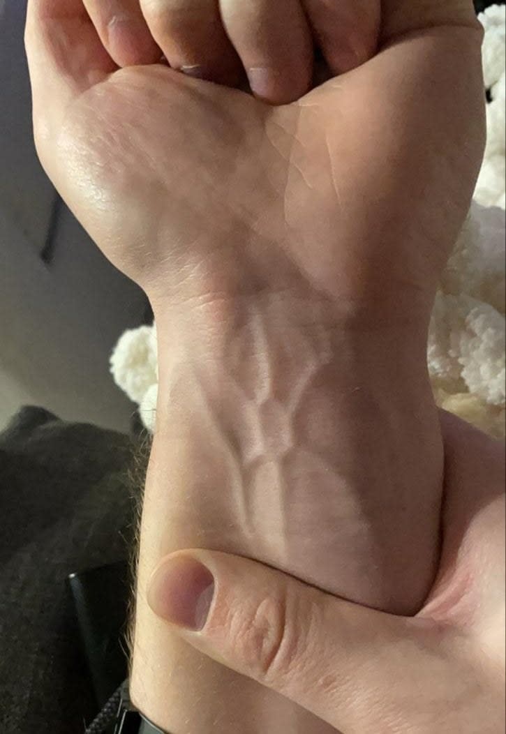 a person's veins shaped like a hexagon