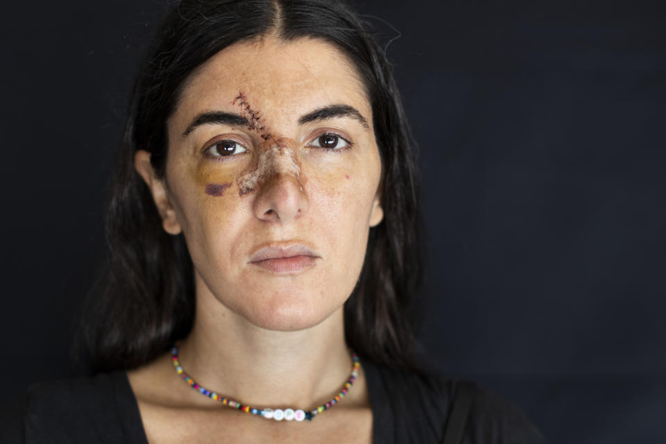 Angelique Sabounjian, who got injured at her office during the Aug. 4 explosion that killed more than 170 people, injured thousands and caused widespread destruction, poses for a photograph in Beirut, Lebanon, Friday, Aug. 14, 2020. (AP Photo/Hassan Ammar)