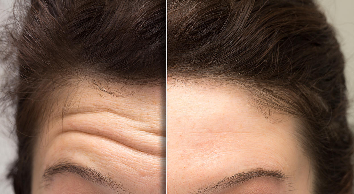 forehead-wrinkle-creams