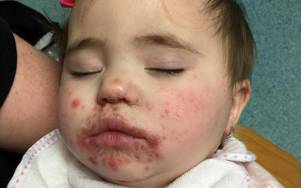 Dolcie-Rae was suffering from hand, foot and mouth disease at Basildon Hospital. Image: SWNS