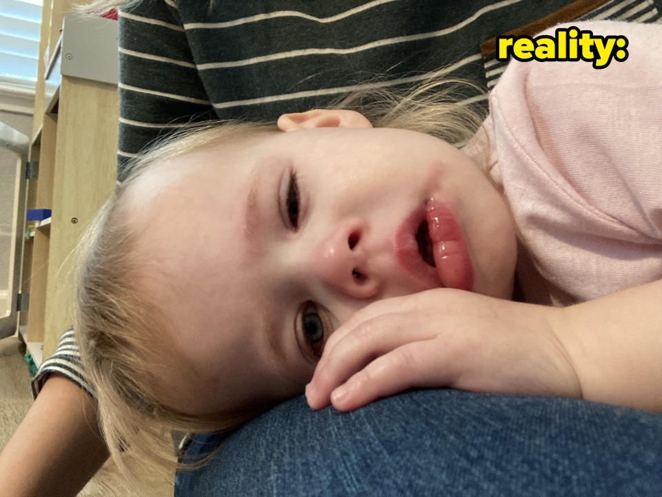 Two year old in anaphylaxis. Lips and eyes are swollen and child looks lethargic