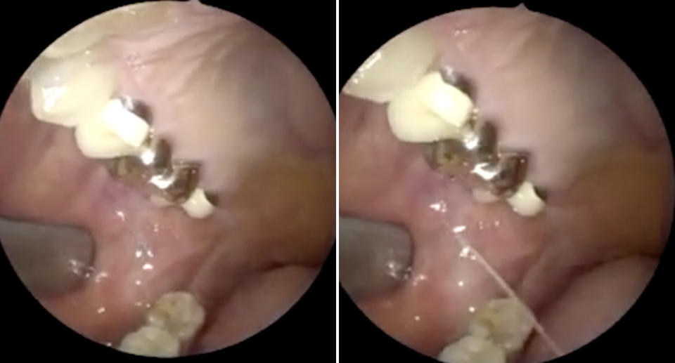 Saliva sprays from a parotid duct in a woman's mouth.