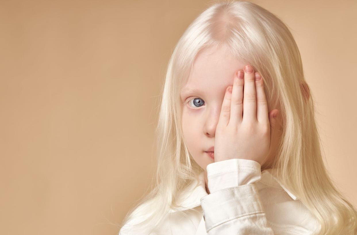 <a href="https://www.shutterstock.com/es/image-photo/albino-cute-caucasian-little-girl-albinism-1739751317" rel="nofollow noopener" target="_blank" data-ylk="slk:UfaBizPhoto/Shutterstock;elm:context_link;itc:0;sec:content-canvas" class="link ">UfaBizPhoto/Shutterstock</a>