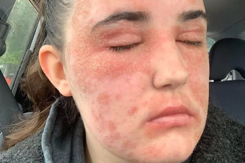 The eczema was so bad that it sealed her eyes and mouth shut