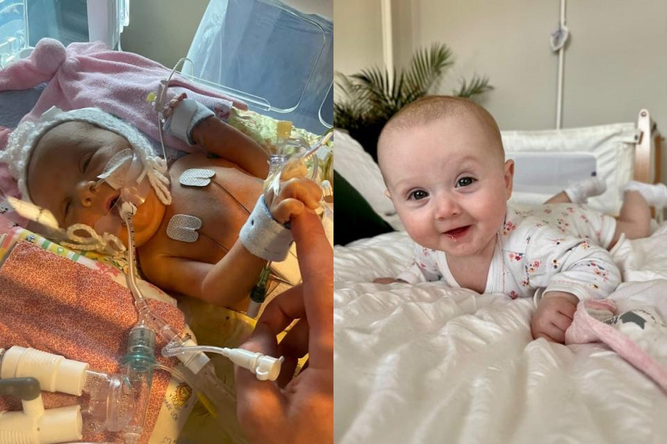 Baby Connie in intensive care and now (Collect/PA Real Life)