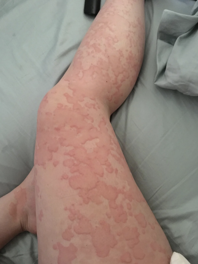 A person’s leg is covered in red, raised, patchy skin, likely indicating a rash or skin condition, as they lie in bed with partially visible blankets