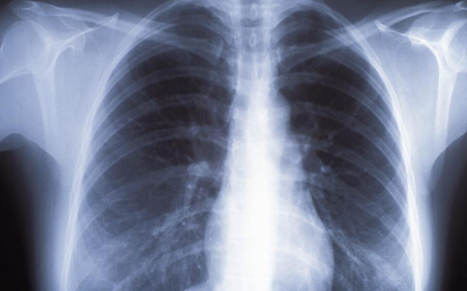 Chest X-rays are the tests GPs order if they suspect lung cancer - Getty Images Fee