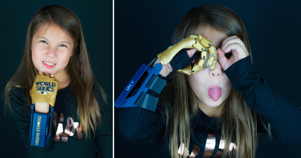 Hailey Dawson, 7, with her 3-D printed World Series hand. (MLB)