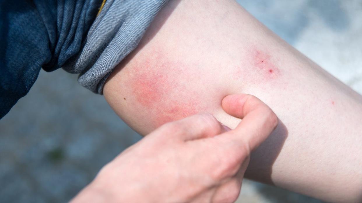 Bitte nicht kratzen! Mückenstiche werden besser gekühlt oder mit einem Präparat aus der Apotheke behandelt. Foto: Andrea Warnecke