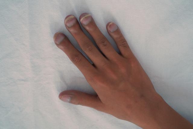 5 Ways Your Hands Are Telling You That Your Liver's in Trouble