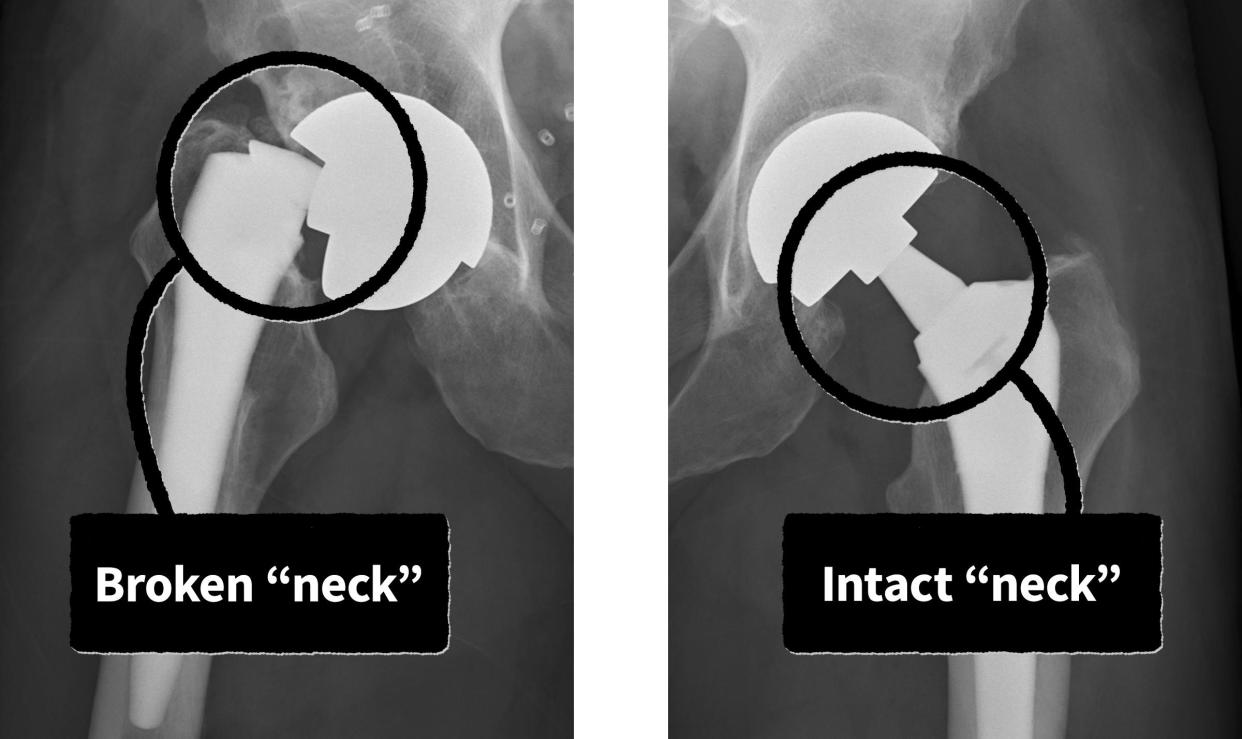 An X-ray of Bradley Little from Sept. 20, 2017, shows that a Profemur artificial hip implanted in his right leg (left side of the photo) broke at the dual modular neck. A second Profemur implant, in his left leg, was intact at the time of this X-ray but broke in a similar incident four years later, Little said. Little filed a lawsuit over both breaks, and Wright Medical Technology denied liability before settling the lawsuit out of court. 