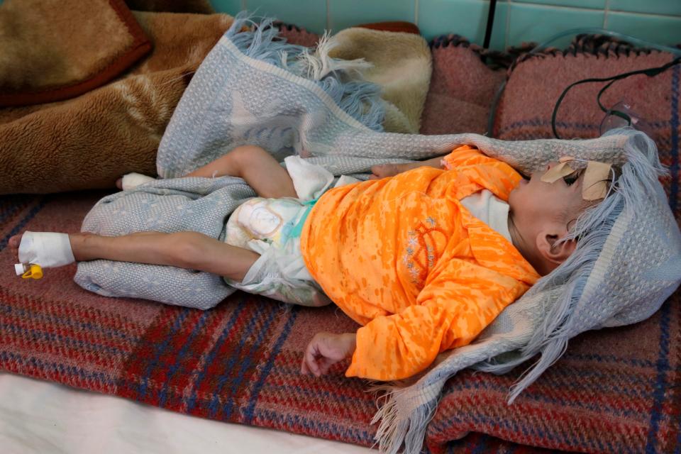 A malnourished infant at a hospital in Sanaa, Yemen, in the fall of 2019. Mass hunger in the country has reduced people's capacity to fight diseases like the novel coronavirus. (Photo: Anadolu Agency via Getty Images)