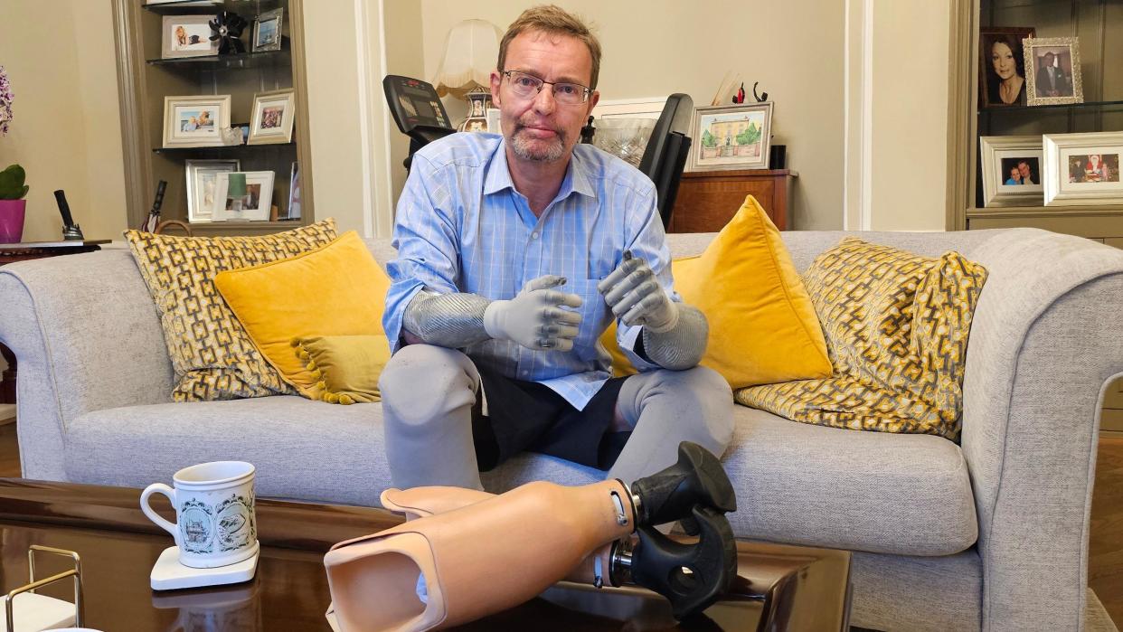 Craig Mackinlay sitting on a sofa at his home, with prosthetic limbs he has paid for and NHS replacement limbs in front of him.