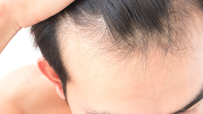 El estilo de vida podría estar detrás de la pérdida de cabello, en los jóvenes. – Foto: Pongsak Tawansaeng/EyeEm/Getty Images