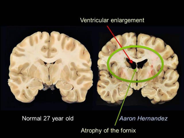 Hernandez's brain scan. Pic: Boston University