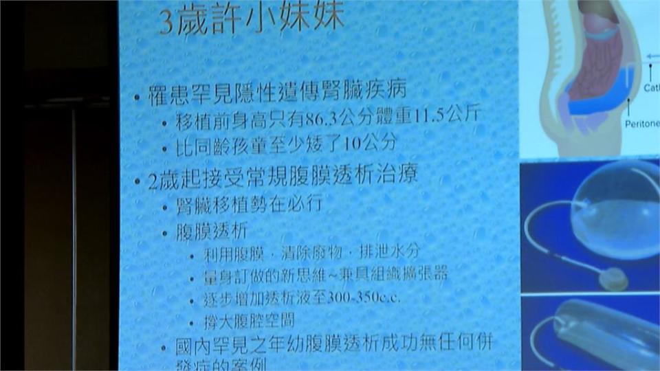 體重相差45公斤！　成人腎臟成功植入3歲女童