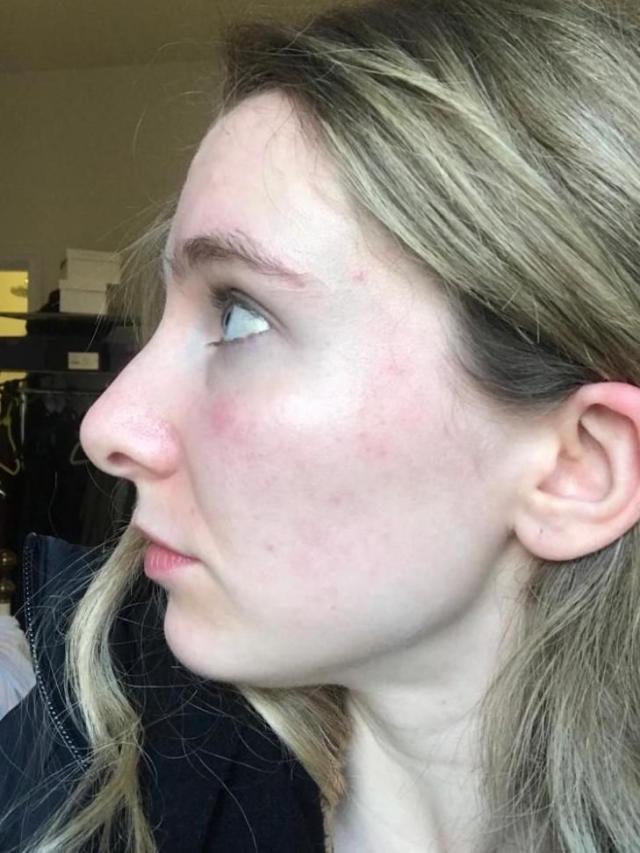 benzoyl peroxide before and after