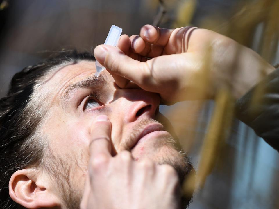 A man with hay fever drips eye drops into his eyes next to a corkscrew hazel bush.