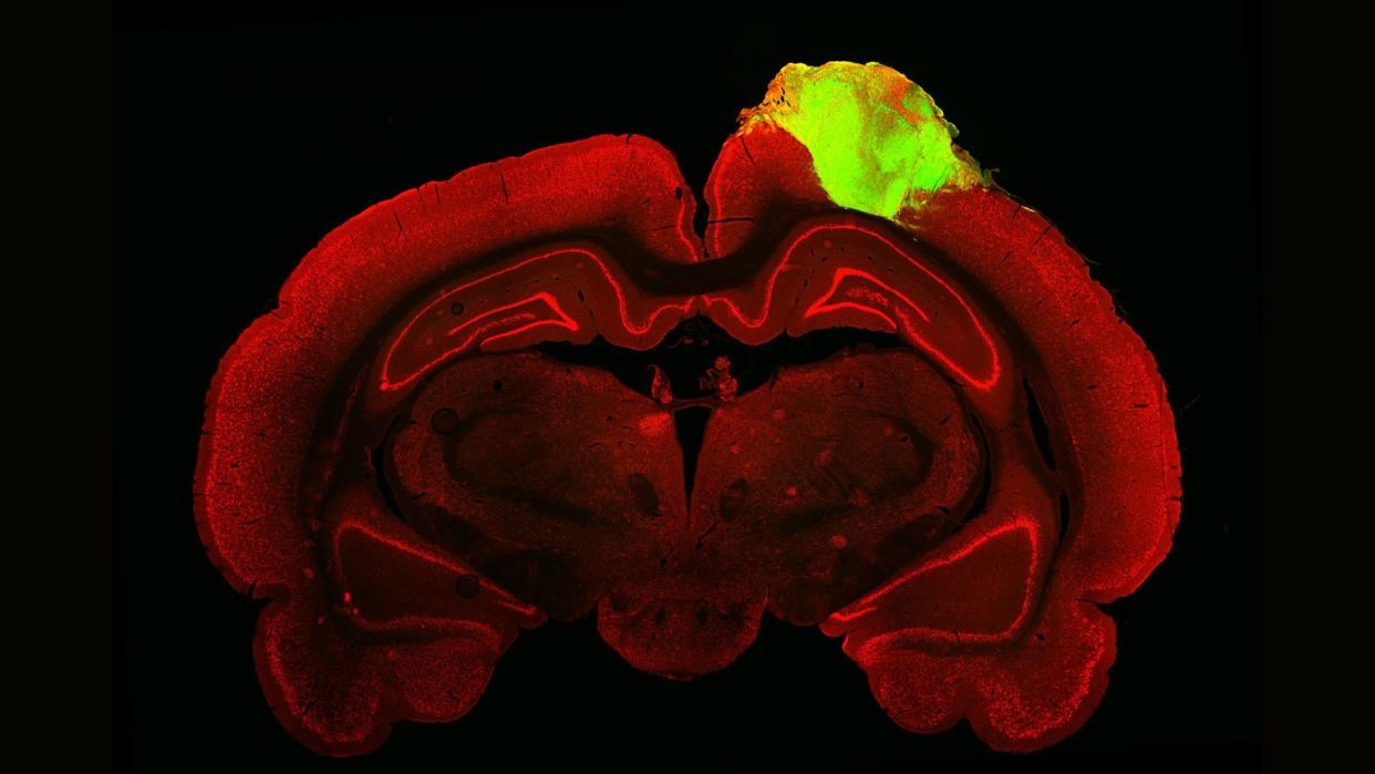  histological image shows a cross section of a rat's brain, depicted in red, with a glowing green blob on the top right side; the blob is a clump of cells called an organoid that's been derived from human stem cells and transplanted into the rat's brain 