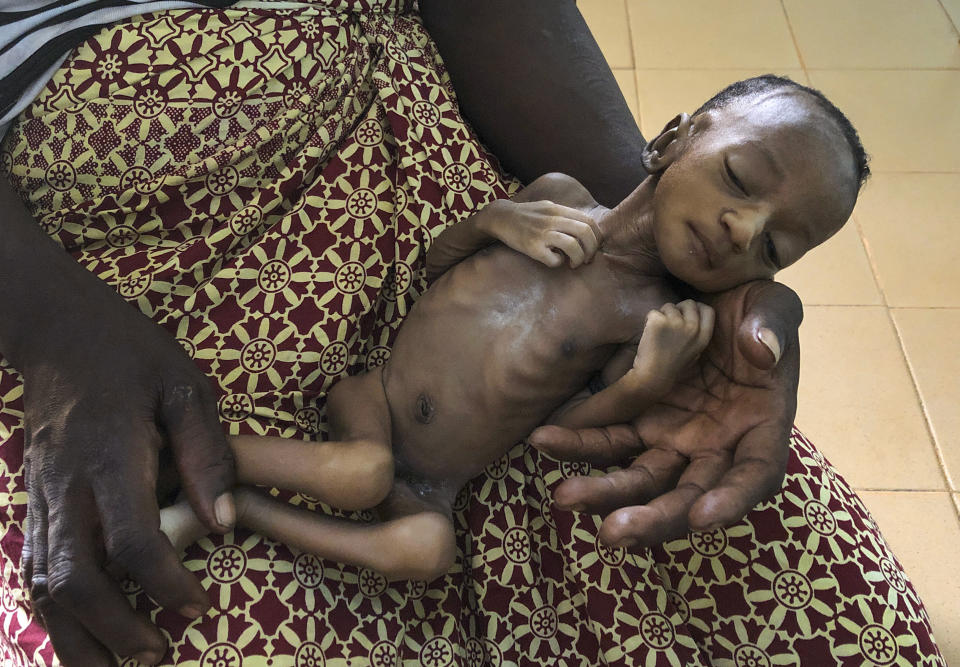 FILE - In this June 11, 2020 file photo, one-month old Haboue Solange Boue, awaiting medical care for severe malnutrition, is held by her mother, Danssanin Lanizou, 30, at the feeding center of the main hospital in the town of Hounde, Tuy Province, in southwestern Burkina Faso. More than 25,000 people will face starvation in conflict-plagued parts of West Africa next year, a United Nations official warned Friday, Dec. 16, 2022. Populations in Nigeria, Mali and Burkina Faso will be in phase five catastrophic hunger by June driven largely by violence as well as economic impacts from the fallout of COVID-19 and the war in Ukraine, said the United Nations Friday. (AP Photo/Sam Mednick, File)