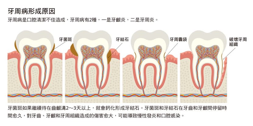 蛀牙-牙周病-顎骨侵蝕-牙齦炎-牙周炎-牙菌斑