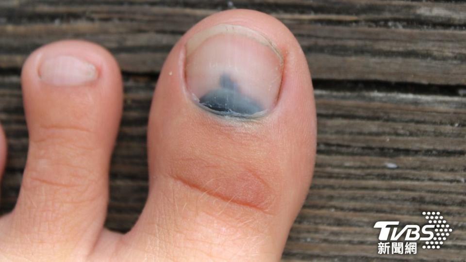 指甲變黑很可能是皮膚癌。（示意圖／shutterestock達志影像）