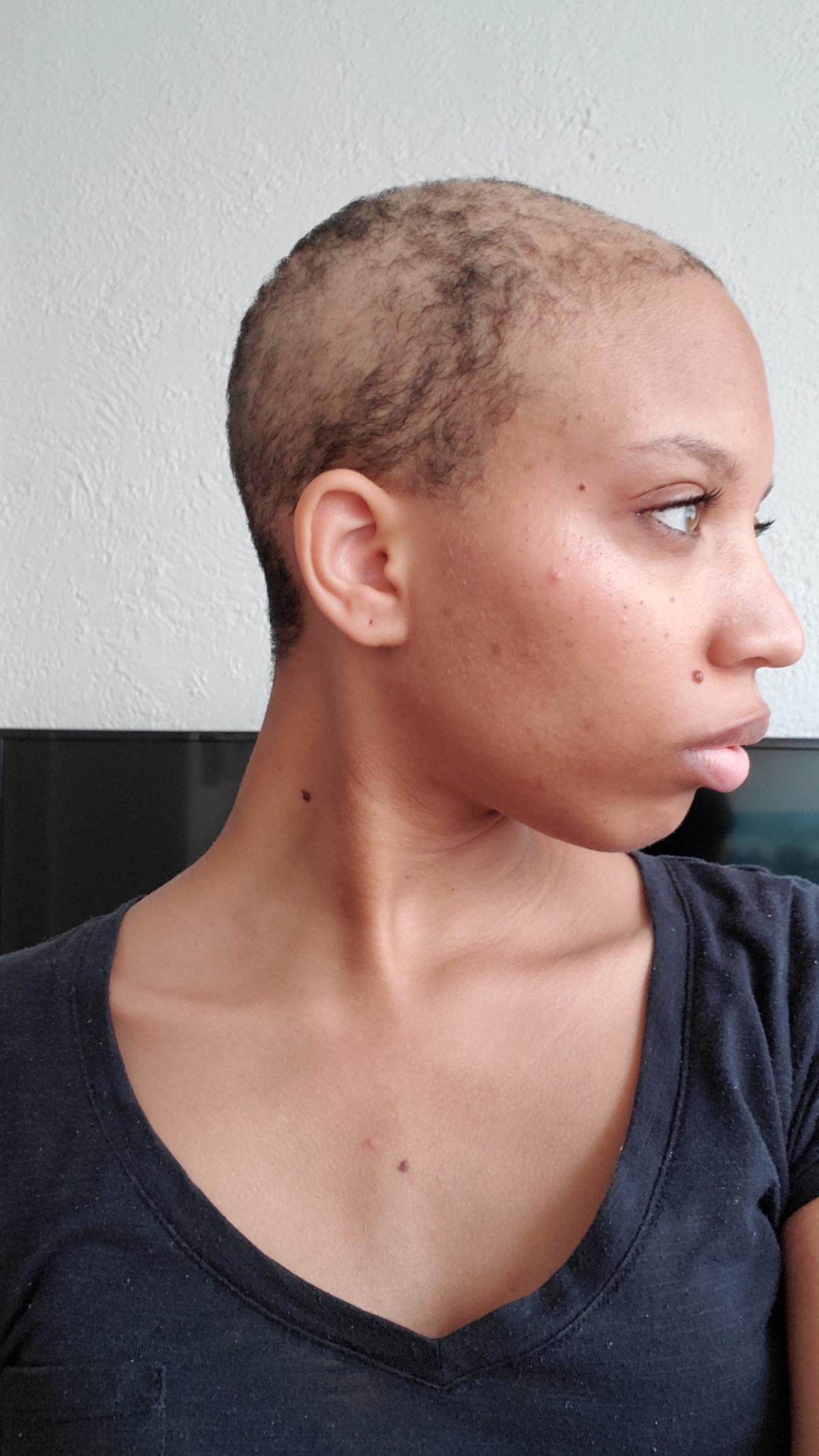 Women Share What It S Like To Live With Trichotillomania I Ve Accepted That I Ll Never Have