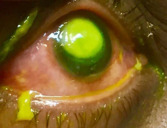 The patient's cornea has been almost consumed by an ulcer, highlighted by dye. (Vita Eye Clinic/ Facebook)