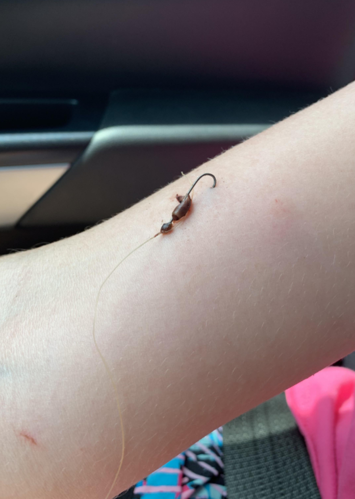 A fish hook in someone's arm