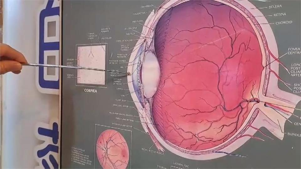 眼鏡行誤把酒精當生理食鹽水　隱形眼鏡戴上灼傷眼視力只剩0.04