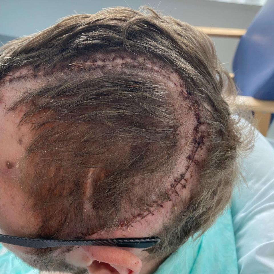 The scars on Jamie Scott's head after emergency surgery