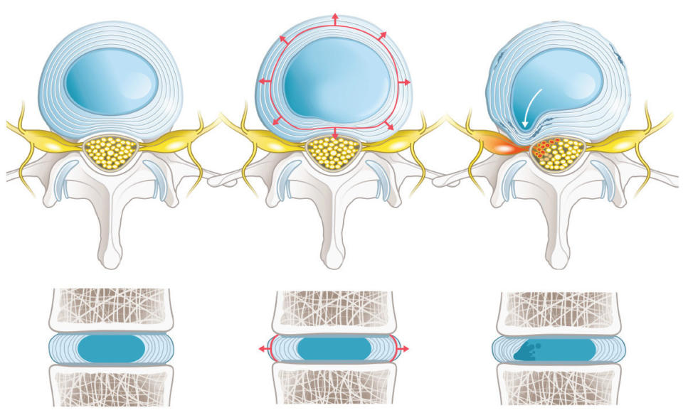 姿勢不正確或突發性傷害，造成纖維環撕裂傷進而引發椎間盤突出。（圖／菁英診所提供）