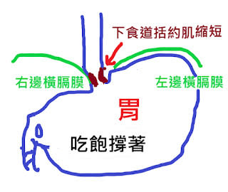 胃食道逆流類型