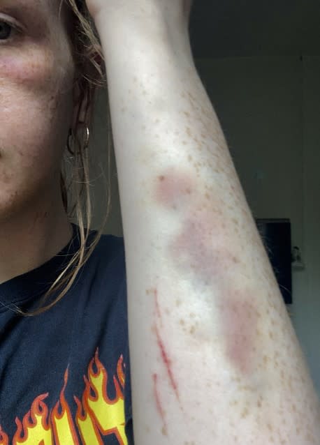 Cait Smith suffered cuts and bruises to her arm and face. (SWNS)