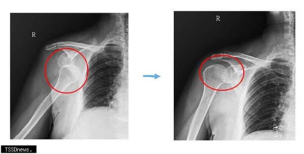 「肩關節脫臼」應儘快處理，否則會導致神經血管的傷害、甚至關節缺血性壞死。<br /><br />（圖：陳建宏醫師提供）