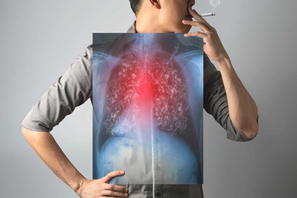 肺癌長期都是本港癌症第一號殺手，成因主要與吸煙、長期吸入二手煙等有關。