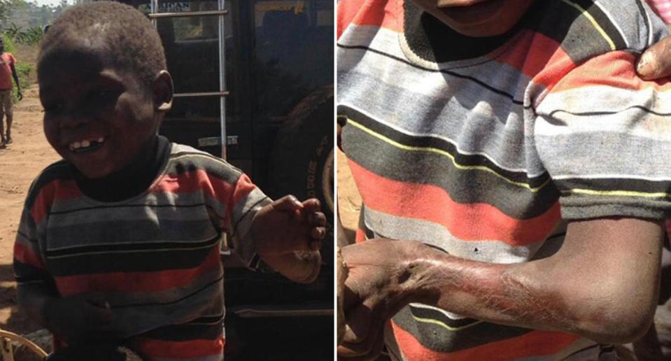 No White Saviors claims a boy pictured here with burns on his arm suffered them at the hands of Renee Bach. Ms Bach is accused of presenting herself as a doctor leading to the deaths of 100 children in Uganda. She's part of a NGO called Serving His Children.