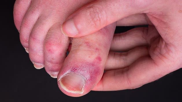 Swelling and soreness can occur (Photo: Chris Curry/Getty)