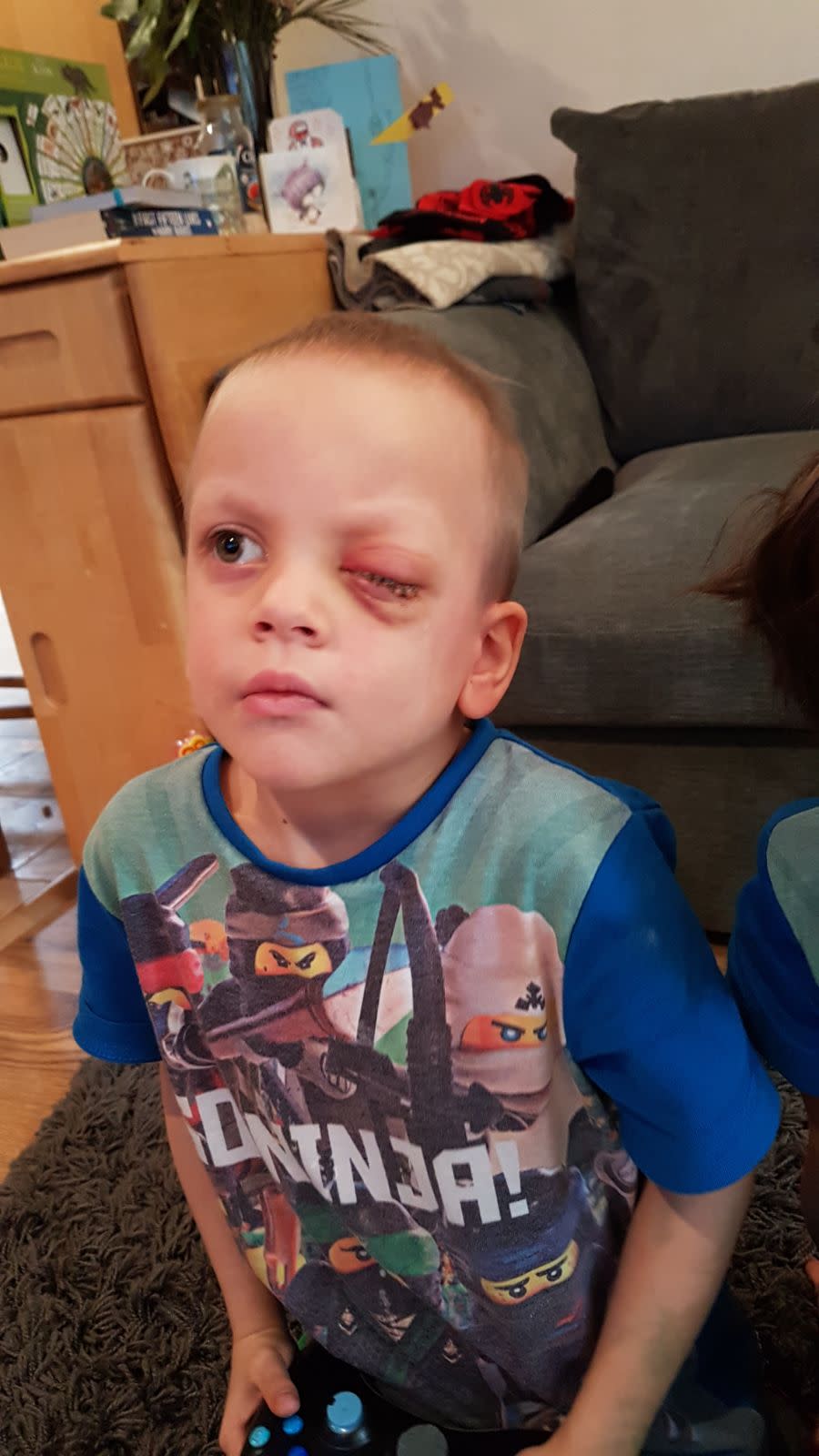 Little Noah had his eye removed in December 2017 [Photo: Laila Gaudry]