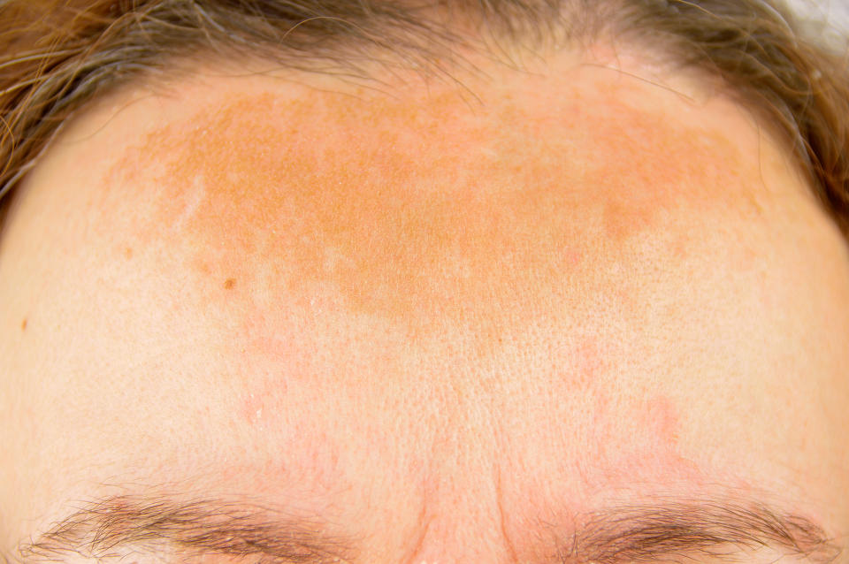 Pigmentation is caused by exposure to the sun [Photo: Getty]