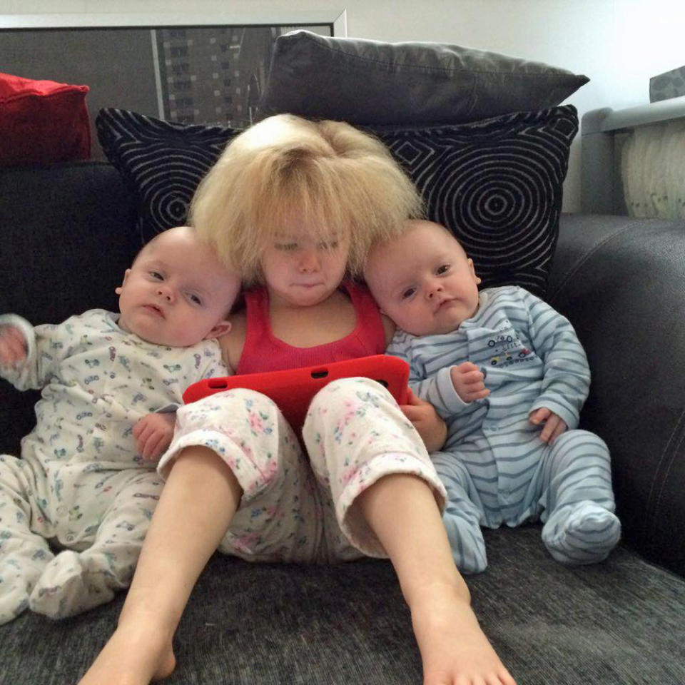 Holly who has uncombable hair syndrome with her brothers Daniel and Charlie (Collect/PA Real Life)