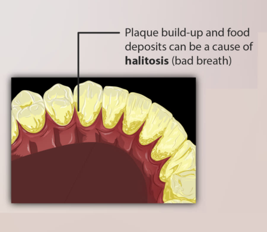 A diagram of teeth and the plaque that can cause halitosis.