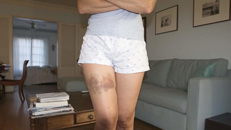 9 Reasons You Bruise So Easily